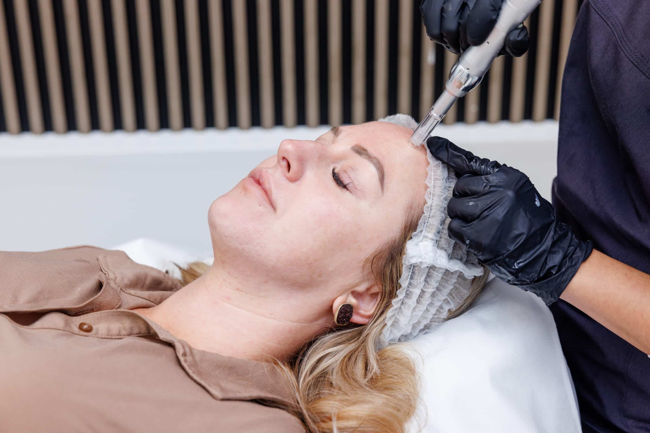 SIGNATURE MICRONEEDLING