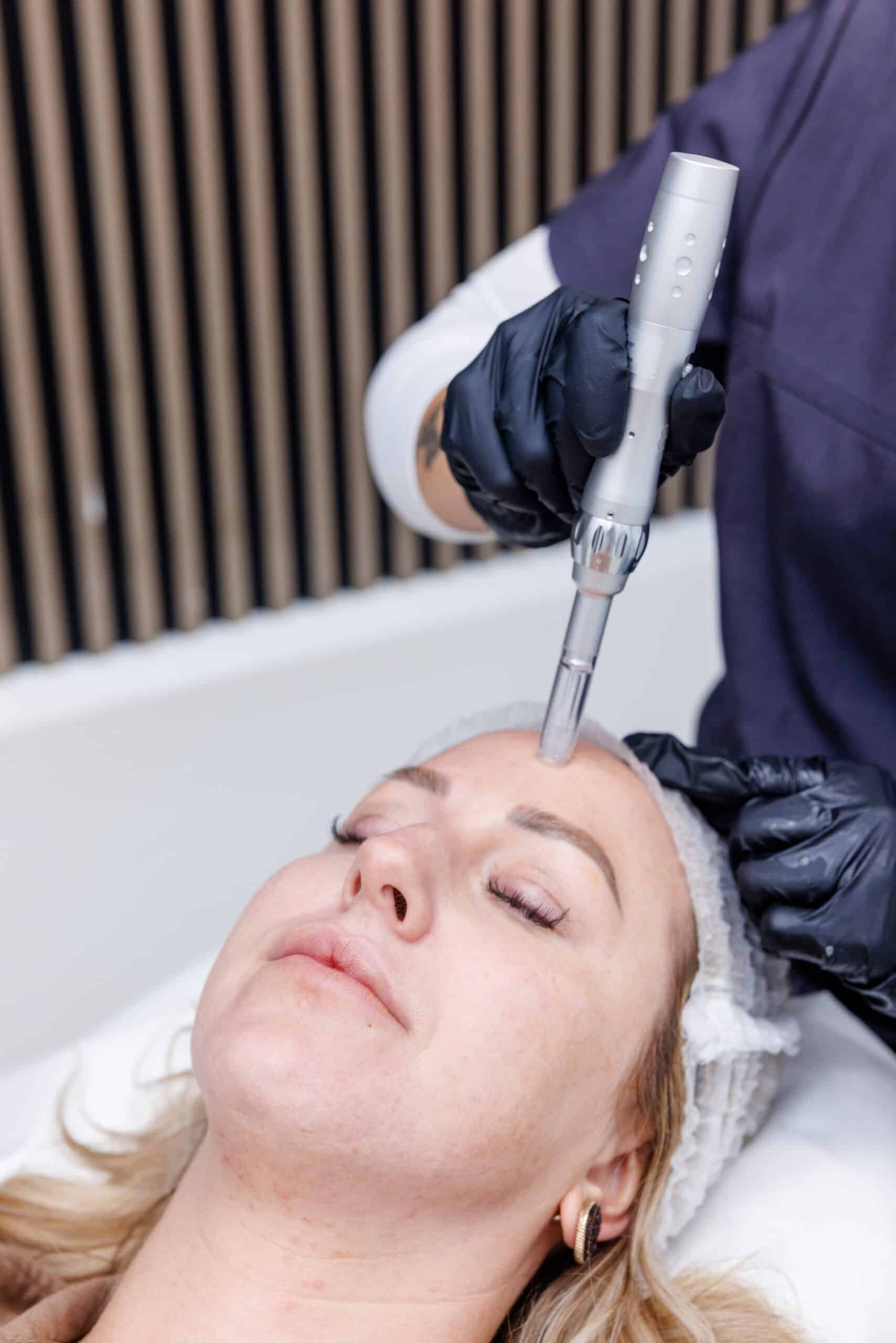 MICRONEEDLING