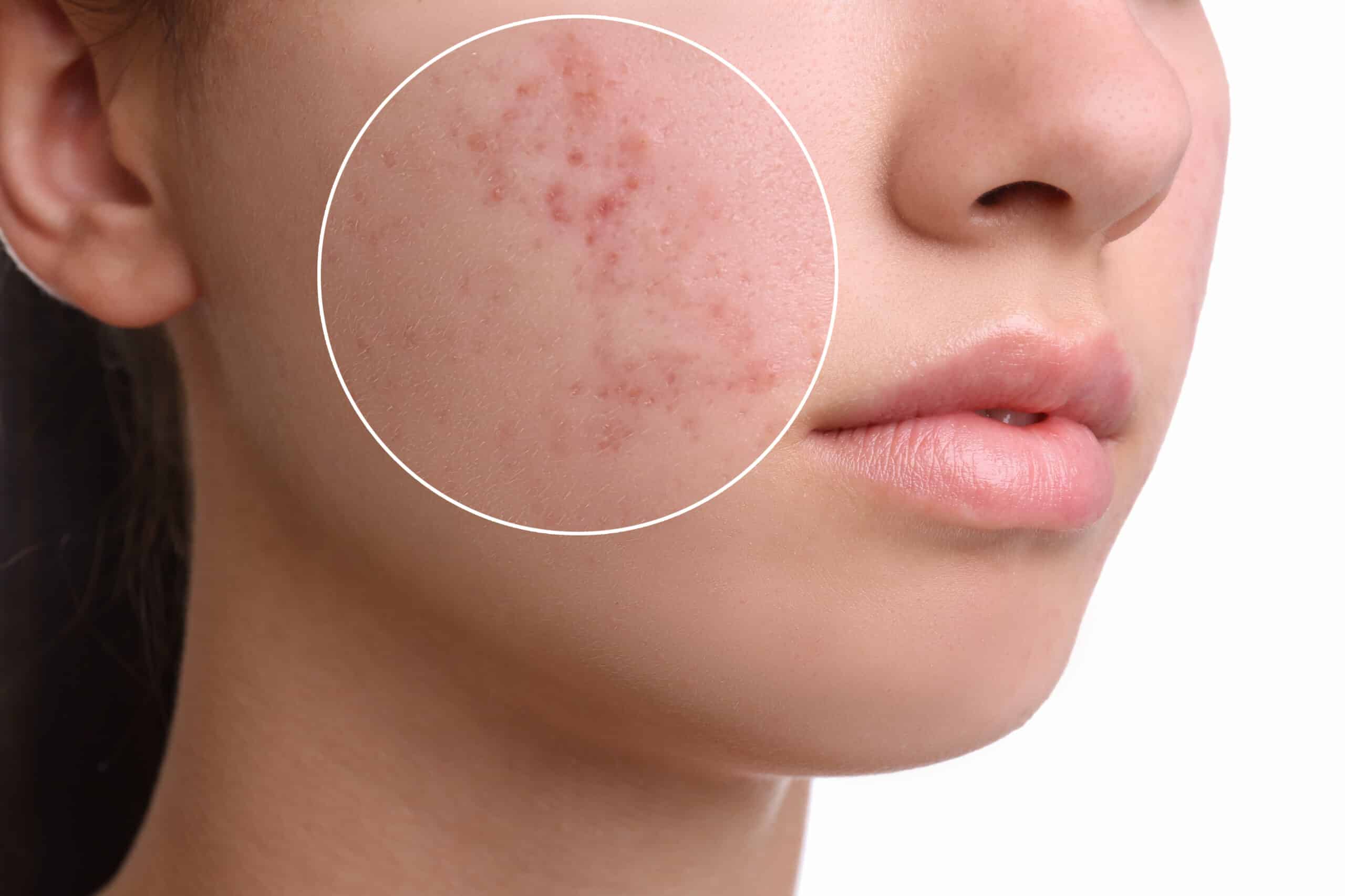 What Causes Acne?
