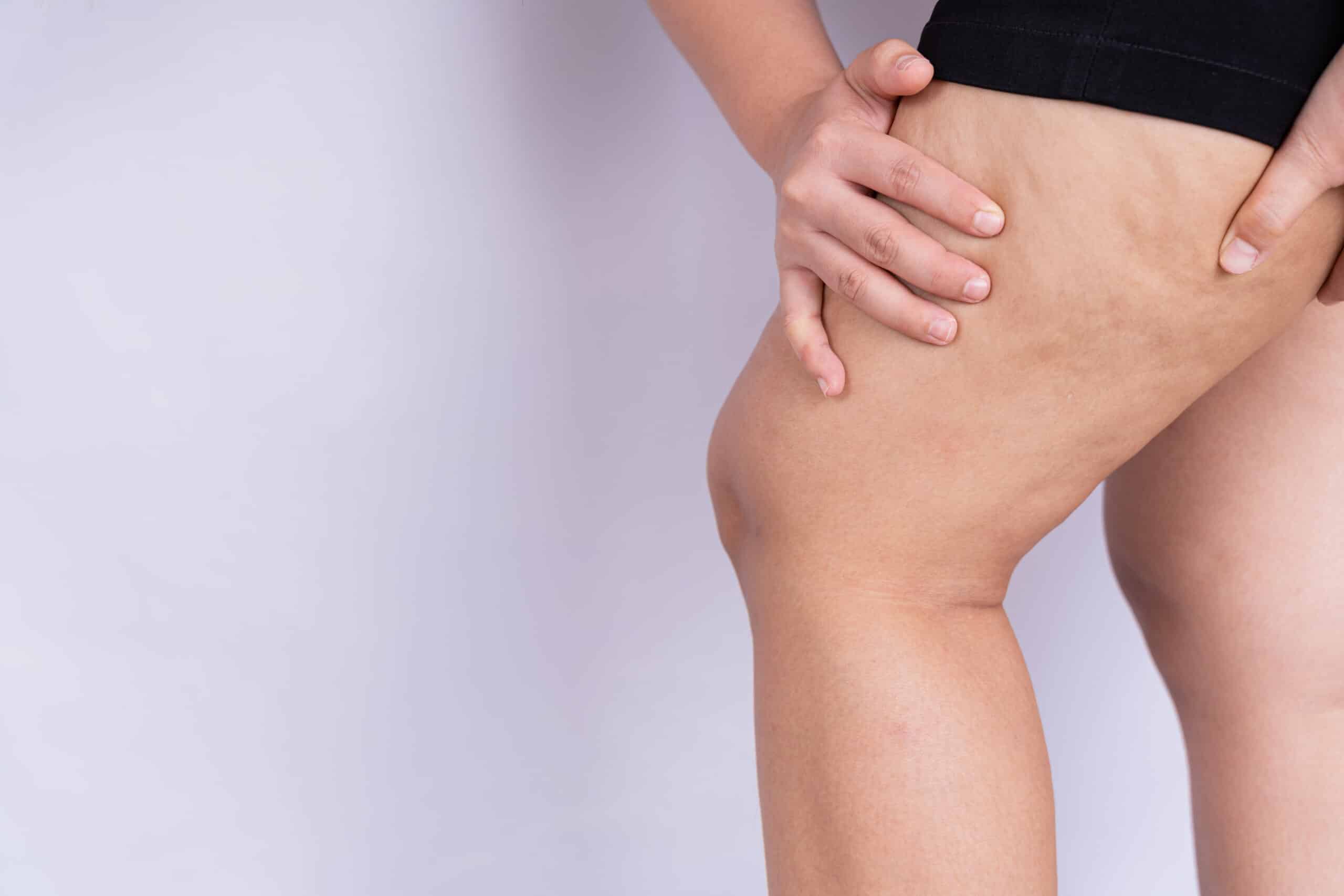 CELLULITE - Novado Skin Care