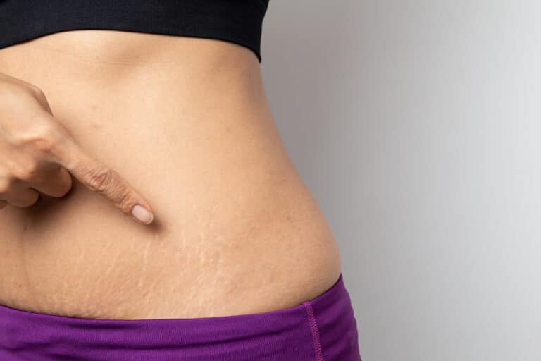 STRETCH MARKS
