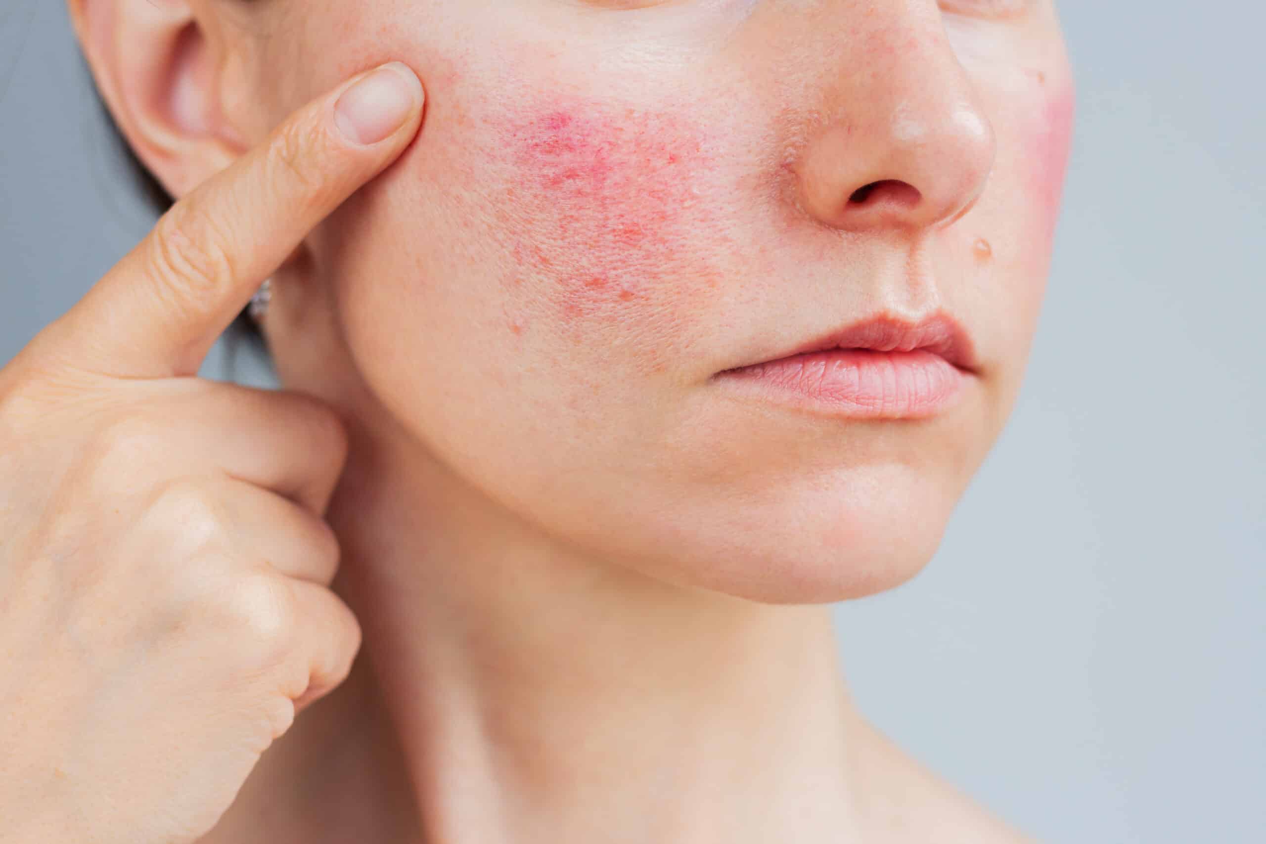 What Causes Rosacea & Redness?